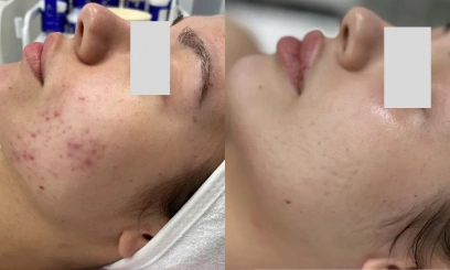 Лечебная чистка + химический пилинг по проблеме  3